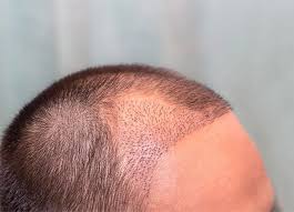 Embark on Your Hair Restoration Journey with Haartransplantation Türkei Kosten